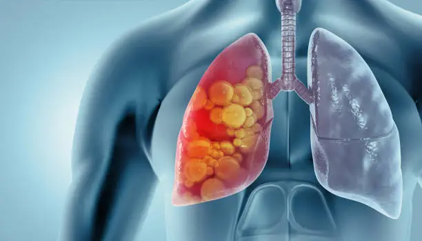 Best Doctor For Tuberculosis in Kurla, Mumbai